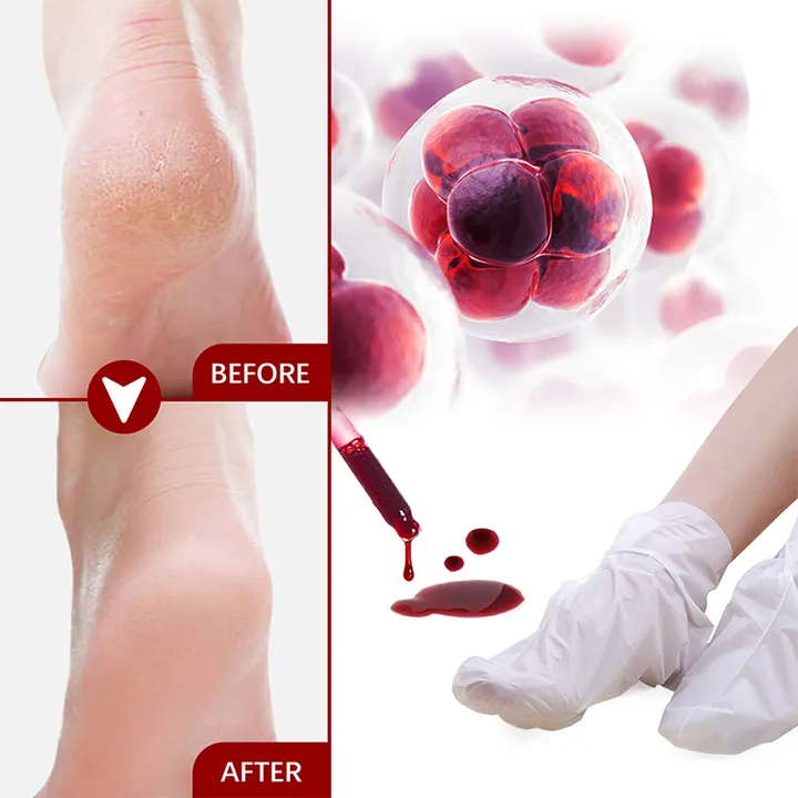 قناع تقشير القدمين لإزالة الجلد الميت والمسامير - Remove Dead Skin and Calluses Exfoliating Peeling Foot